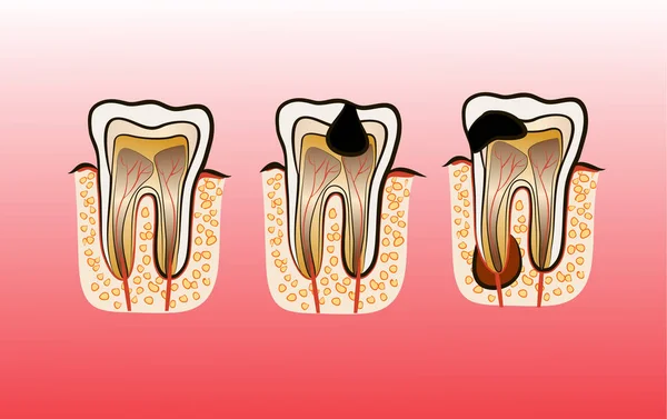 Ilustração vetorial de cáries de cárie dentária — Vetor de Stock