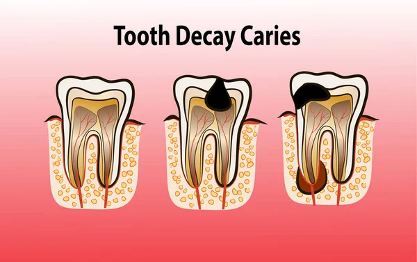 Illustration vectorielle des caries de carie dentaire — Image vectorielle