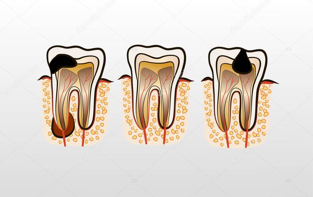 Vector illustration of tooth Decay Caries