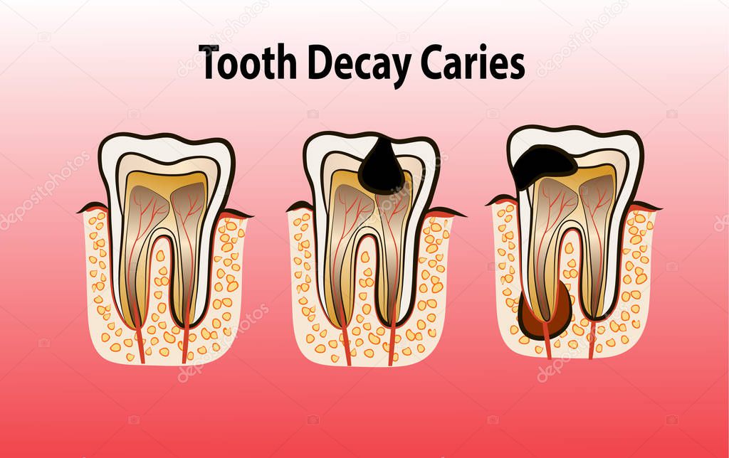 Vector illustration of tooth Decay Caries