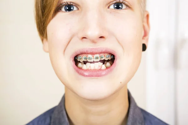 Orthodontie et correction des morsures . — Photo