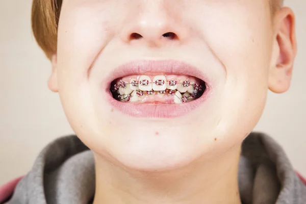 Orthodontie et correction des morsures . — Photo