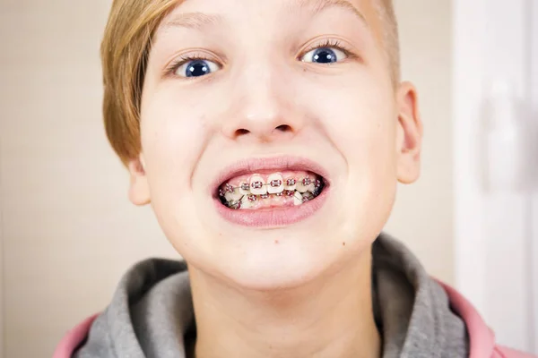 Ortodontia e correção de mordida . — Fotografia de Stock