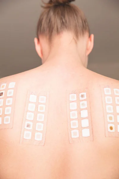 Allergy skin test — Stock Photo, Image