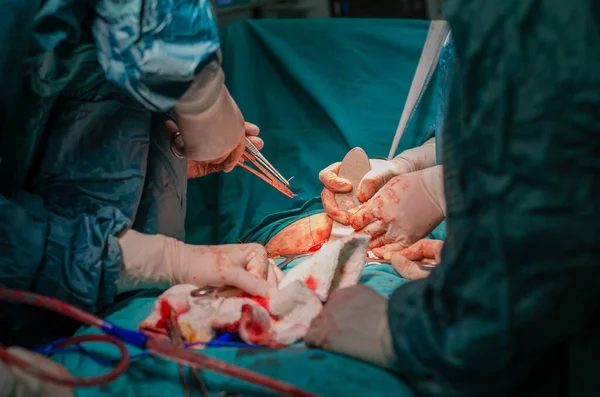 Cirugía Histerectomía Médico Cirujano Masculino Enfermeras Operación — Foto de Stock