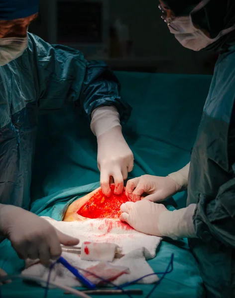 Médico Concentrado Asistente Durante Una Histerectomía Hospital Abrir Abdomen Durante —  Fotos de Stock