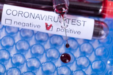 2019-NCoV, Wuhan, Çin. Coronavirus Laboratuvarı 'nda Coronavirus virüsü kan testi. Tıbbi test listesi.