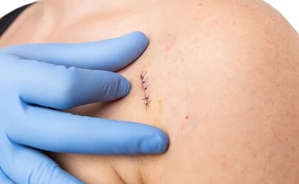 Dermatolog veya plastik cerrahi doktor kalıp kaldırma st kontrol