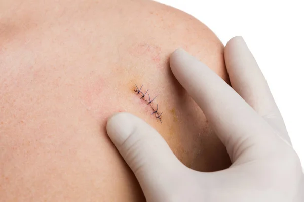 Manos médicas o enfermeras examinando sutura fresca en el hombro de la mujer — Foto de Stock