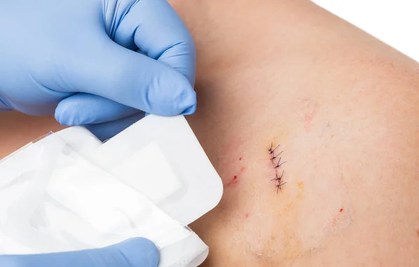 Doctor hands patching stitched surgery with new sterile bandage — Stock Photo, Image