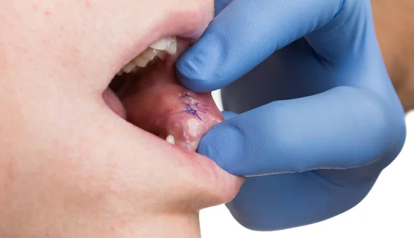 Doctor hand checking inside mouth polyps removal stitches