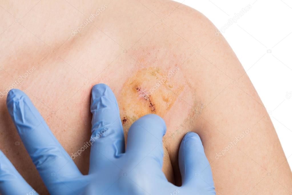 Doctor hand checking surgery suture after mole removal