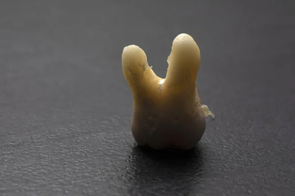 Ausgerissene menschliche Zähne. Wurzel aus. Zahn um Zahn. Verdorbener Zahn auf schwarzem Hintergrund. — Stockfoto