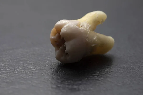 Verdorbener menschlicher Zahn auf schwarzem Hintergrund — Stockfoto