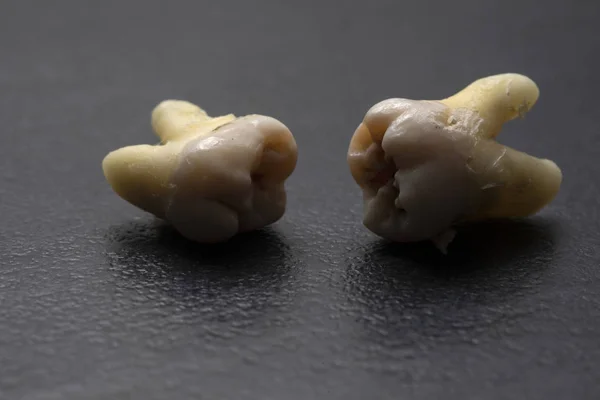 Dos dientes humanos rotos sobre un fondo negro. Pérdida de dientes . Imagen de stock