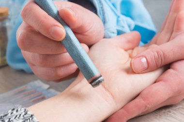 terapist Moxa tedavi yapıyor