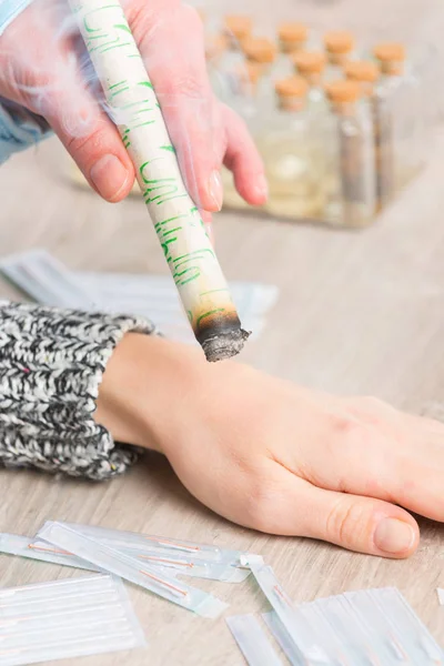 Therapist doing moxa treatment — Stock Photo, Image