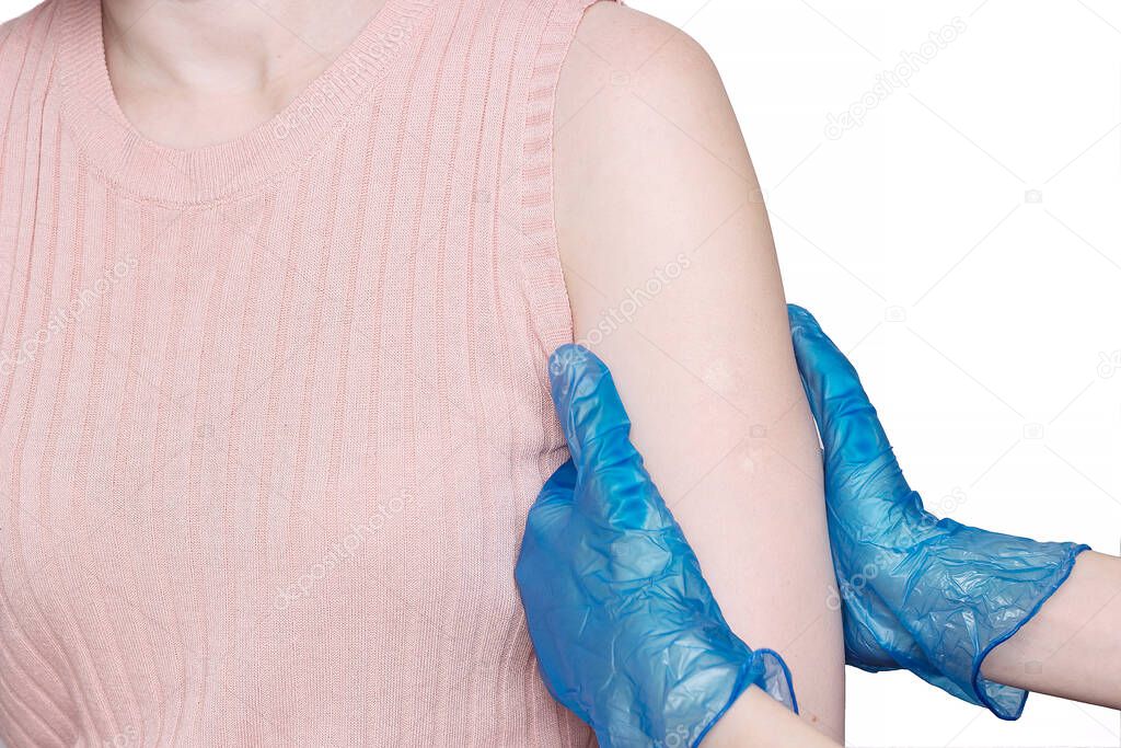 Doctor or nurse examine tuberculosis vaccine BCG marks on the shoulder of an adult woman made in childhood