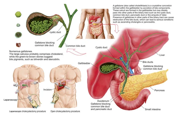 Ilustración Médica Cálculos Biliares Vesícula Biliar Colecistectomía — Foto de Stock