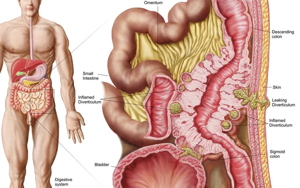 Ilustración Médica Diverticulosis Colon —  Fotos de Stock