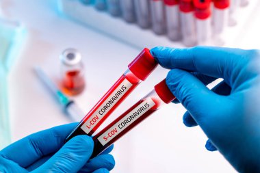 Tıbbi eldiven giyen doktor Coronavirus 2019-nCoV S-cov ve L-Cov kan örneği içeren bir kan tüpü tutuyor..