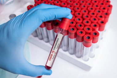 Coronavirus 2019-ncov kan örneği. Corona virüsü salgını. Salgın Virüsü Solunum Sendromu.