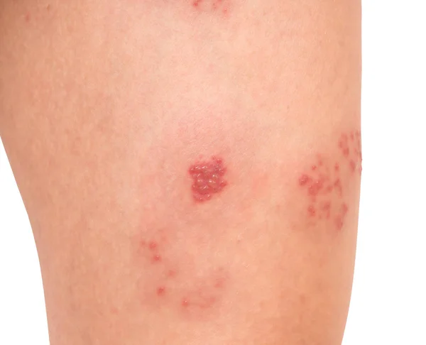 Cilt virüslü Herpes zoster virüs.