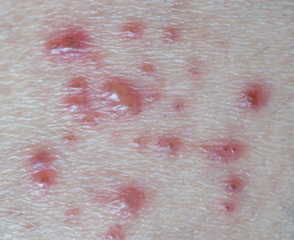 Haut infizierte Herpes-Zoster-Viren. — Stockfoto