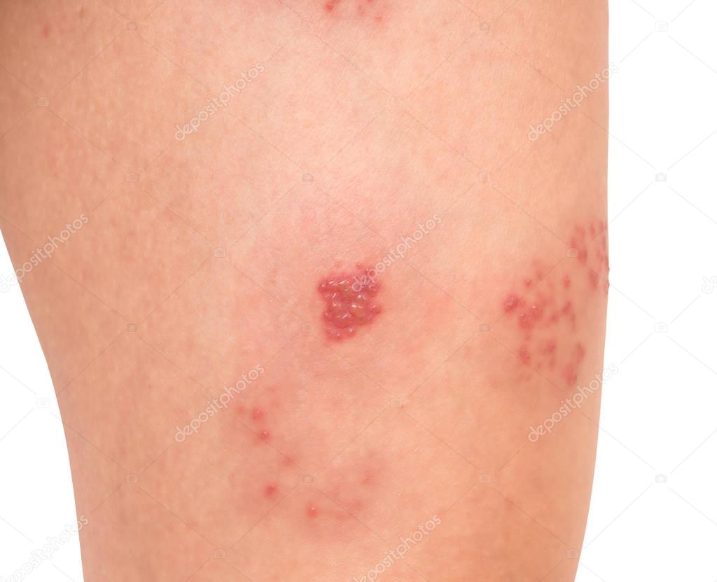 Skin infected Herpes zoster virus.