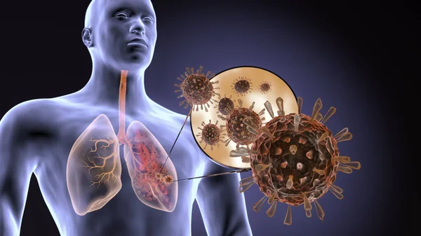 Коронавірус Вражає Легені Людини Спричиняє Пневмонію Інфекція Лунгів Covid Vcov — стокове фото