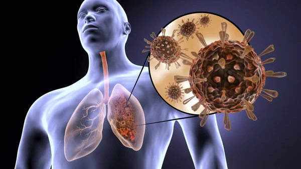 Coronavirus Ataca Los Pulmones Humanos Causa Neumonía Infección Pulmonar Covid Imagen de stock