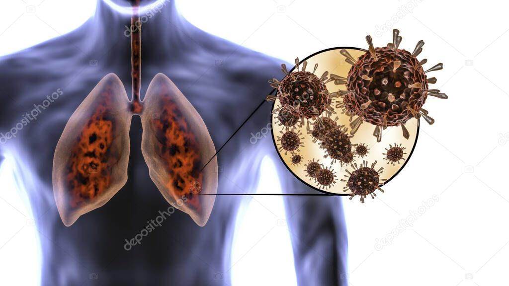 Coronavirus attacks human lungs and causes pneumonia. Lung infection - covid-19, vcov 2019. Microscope virus close up - 3d render.