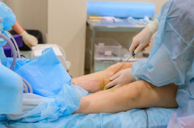 Estetik cerrahi yağ aldırma. Şişman bir kadının bacaklarından yağ alma süreci. Yüzü olmayan, tanınmayan bir hasta..