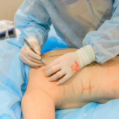 Liposuction process in aesthetic surgery clinics. The surgeon makes an incision on the back of an obese woman to pump out excess fat.