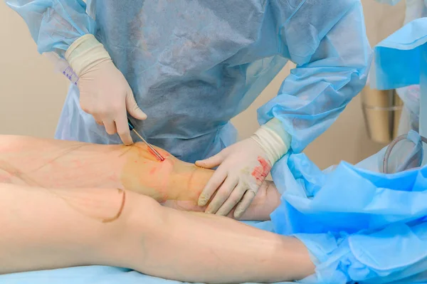 Kozmetikai sebészeti zsírleszívás. A zsírleszívás folyamata egy kövér nő lábán. Arc nélkül felismerhetetlen beteg.. — Stock Fotó