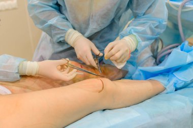 Surgeons suture their knees after liposuction. Close-up of plastic surgery to remove excess fat.