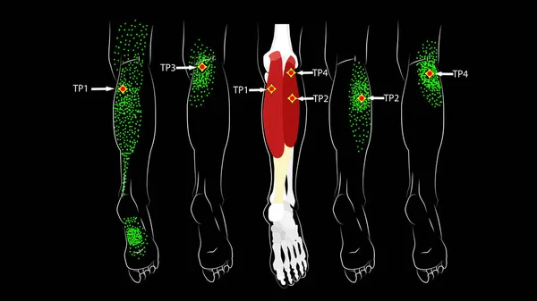 Kalvmuskel. Trigger pekar i benet, reflekterade smärta på baksidan av låret och i foten. Bensmärta — Stock vektor
