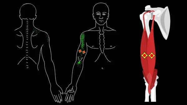 Musculus biceps brachii. Biceps trigger points and pain