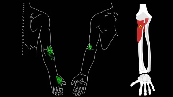 Supinatormuskeln. Trigger punkter i musklerna i händerna. — Stockfoto