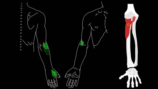 Supinator muscle. Trigger points in the muscles of the hands. — Stock Photo, Image