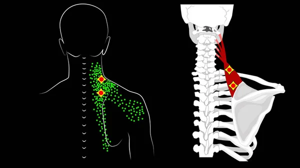 Levator Schulterblatt Muskel. Triggerpunkte und Muskelstruktur. Schmerzen im Nacken und Schulterblatt. — Stockfoto