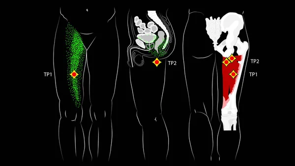 Adductor muscles of the hip. Trigger points and reflected pain on the inside of the thigh.