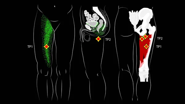 Управляющие мышцы бедра. Триггер указывает и отражает боль на внутренней стороне бедра . — стоковое фото