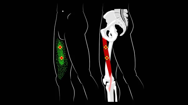 Gracilis Muskel. Struktur, Triggerpunkte und reflektierte Schmerzen im Oberschenkelmuskel — Stockfoto