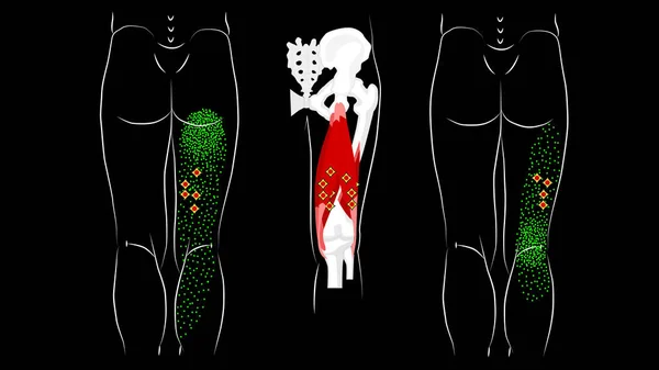 Триггер указывает и отражает боль в мышцах подколенного сухожилия . — стоковое фото