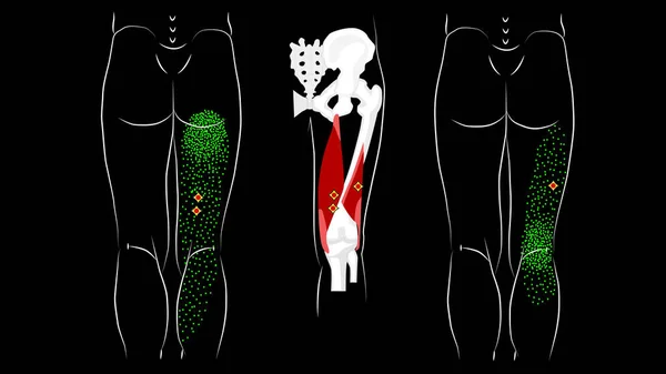 Триггер указывает и отражает боль в мышцах подколенного сухожилия — стоковое фото