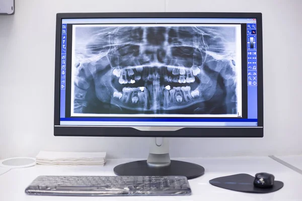 Um raio-X no monitor — Fotografia de Stock