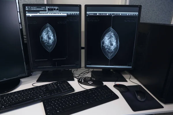 Mammographie Bild Auf Bildschirmen Einem Krankenhauslabor — Stockfoto