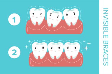 dişleri ile mavi arka plan üzerinde görünmez diş telleri