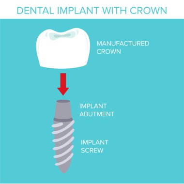 taç ile bir diş implantı çizimi